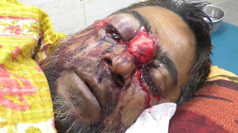 বগুড়ায় বিএনপি-জামায়াত সংঘর্ষ: নেতার চোখ হারানোর খবরে মায়ের মৃত্যু