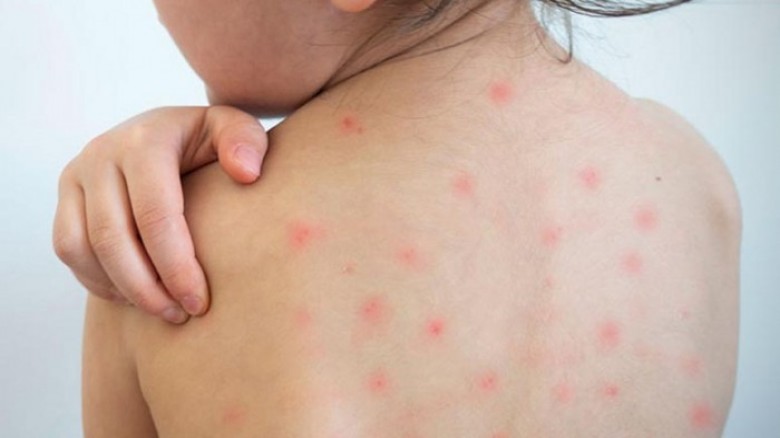 দেশজুড়ে হামের প্রকোপে আতঙ্ক: ১৯ দিনে ৯৪ জনের মৃত্যু