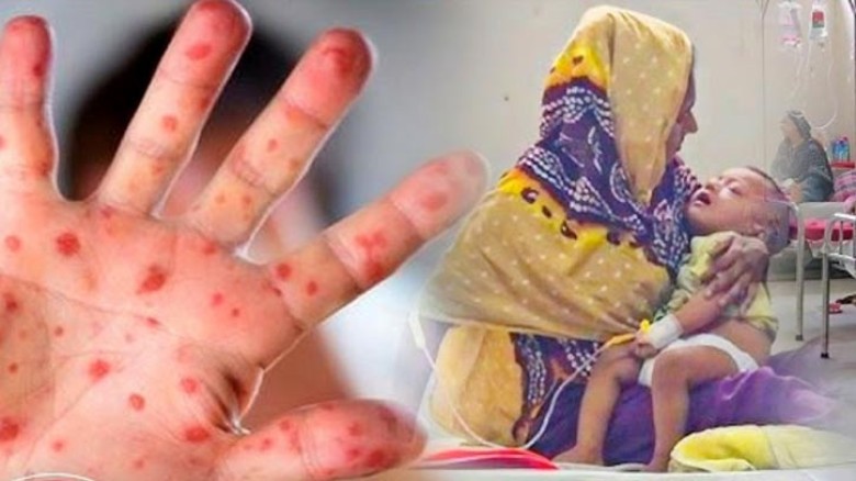 ২৪ ঘণ্টায় হাম ও হামের উপসর্গে ৭ জনের মৃত্যু