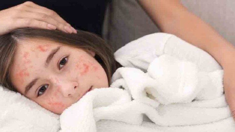 হাম ও হামের উপসর্গ নিয়ে আরও ১১ শিশুর মৃত্যু, আক্রান্ত ১২৩৬