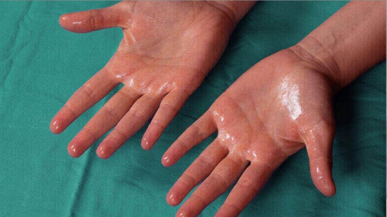 হাইপারহাইড্রোসিস: অতিরিক্ত ঘামের কারণ ও প্রতিকার