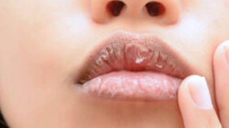 শুধু শীত নয়, গ্রীষ্মেও ফাটে ঠোঁট, কীভাবে যত্ন নেবেন?