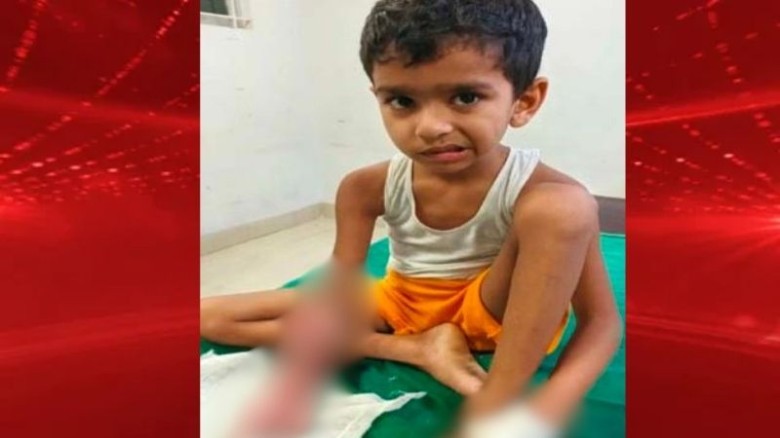 ভুল চিকিৎসায় শিশুর চারটি আঙুল কাটা