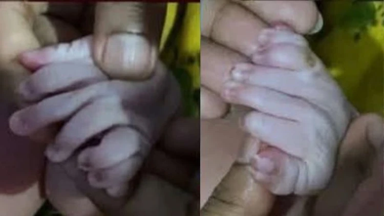 ৩০ আঙুলের সেই বিরল নবজাতকের মৃত্যু