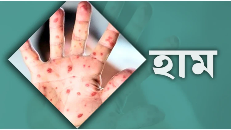 হামের উপসর্গে আরও ৬ শিশুর মৃত্যু, মোট প্রাণহানি বেড়ে ৯০৮