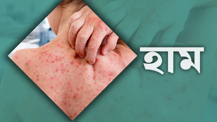 হামের উপসর্গে ২৪ ঘণ্টায় ৬ জনের মৃত্যু